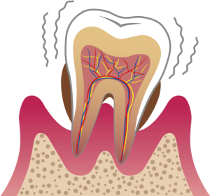 歯周病